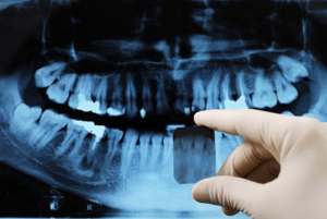 What Do Cavities Look Like on X Ray