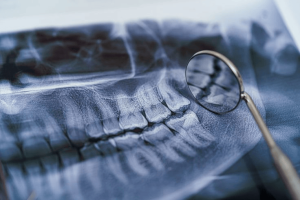 What Do Cavities Look Like on X Ray