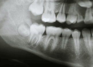 What Do Cavities Look Like on  X Ray